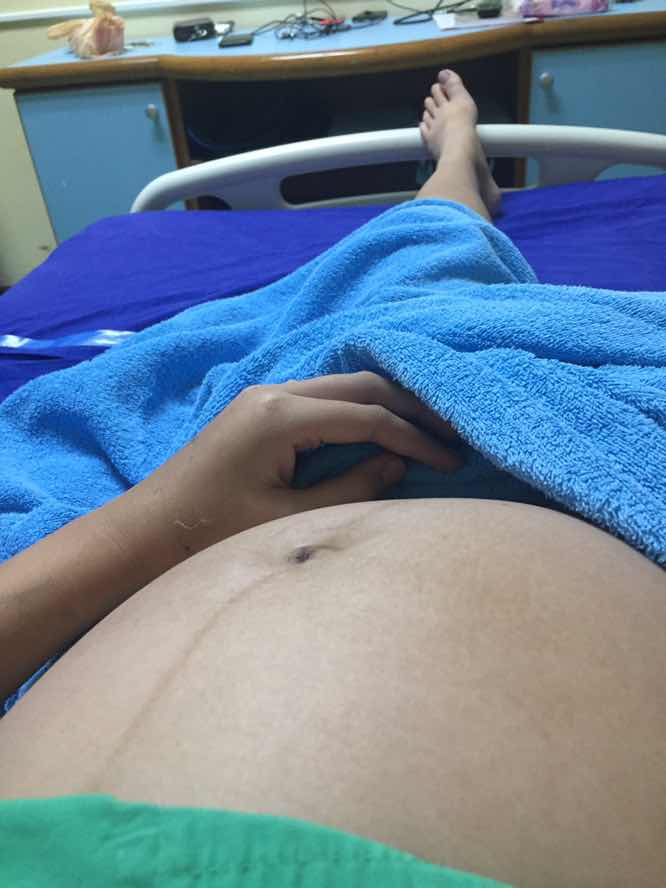 ภาวะคลอดก่อนกำหนด