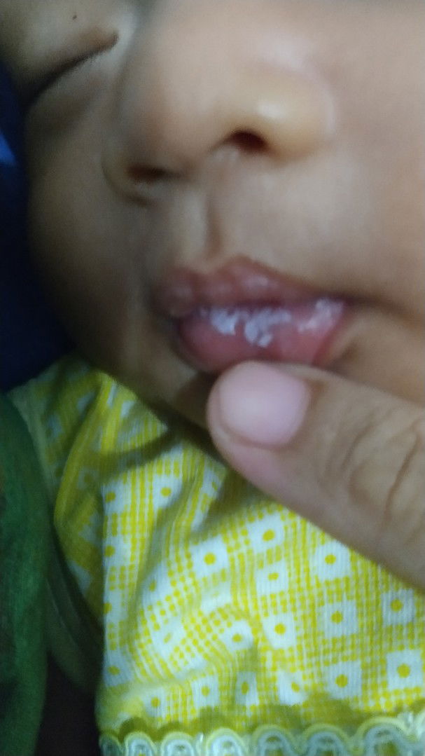 Bibir dan lidah bayi putih