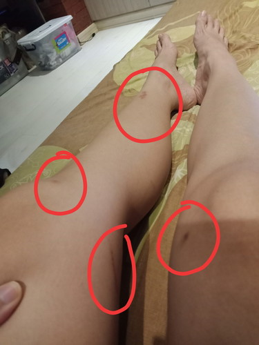 Bruises