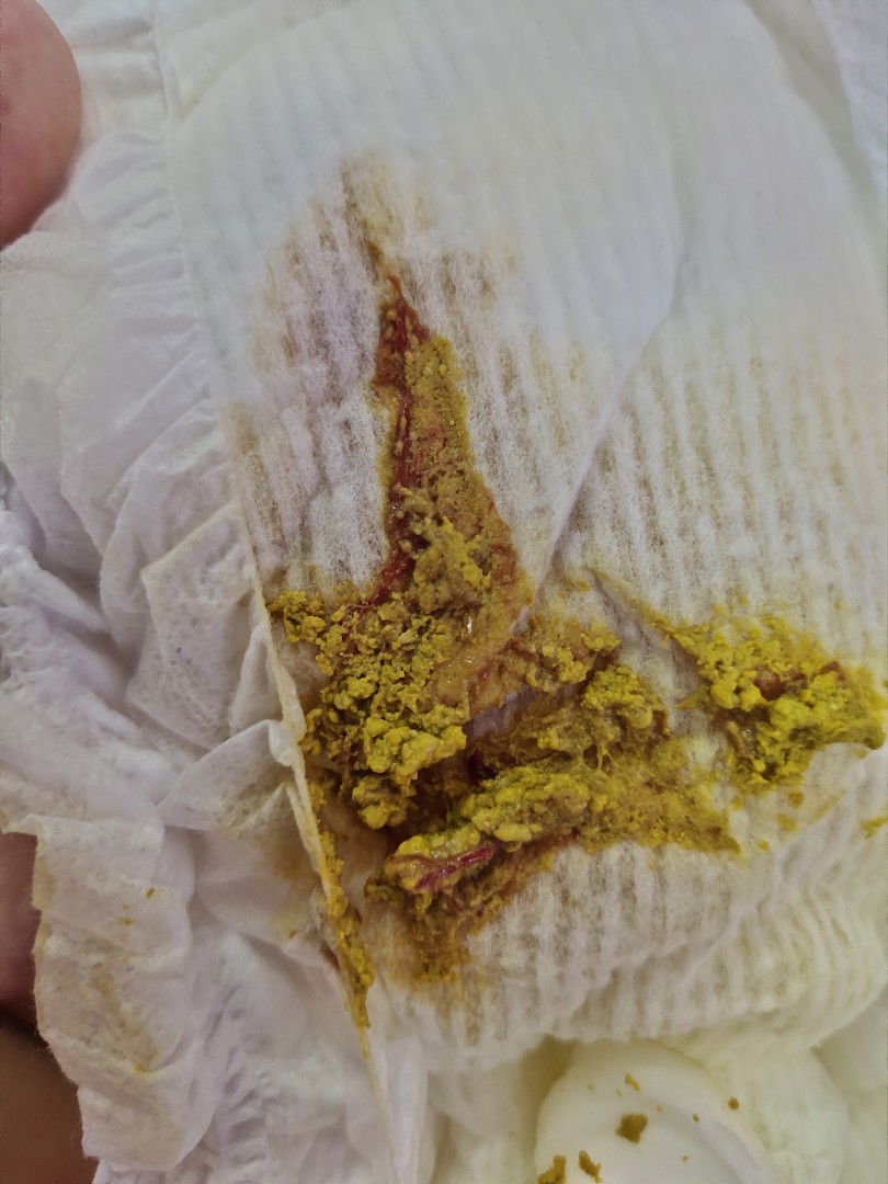 ลูก 18 วันลำไส้อักเสบ