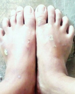 gatal2