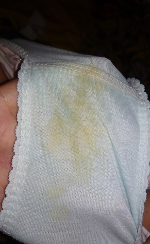 keputihan berwarna kuning yang sudah lumayan lama