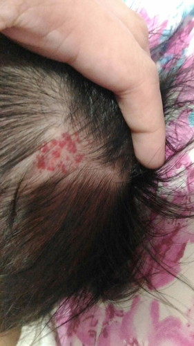 birthmark??