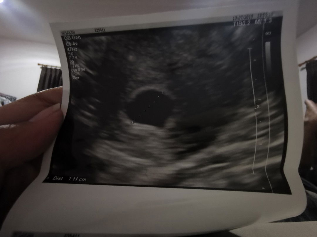 ไม่พบลูกในถุงตั้งครรภ์