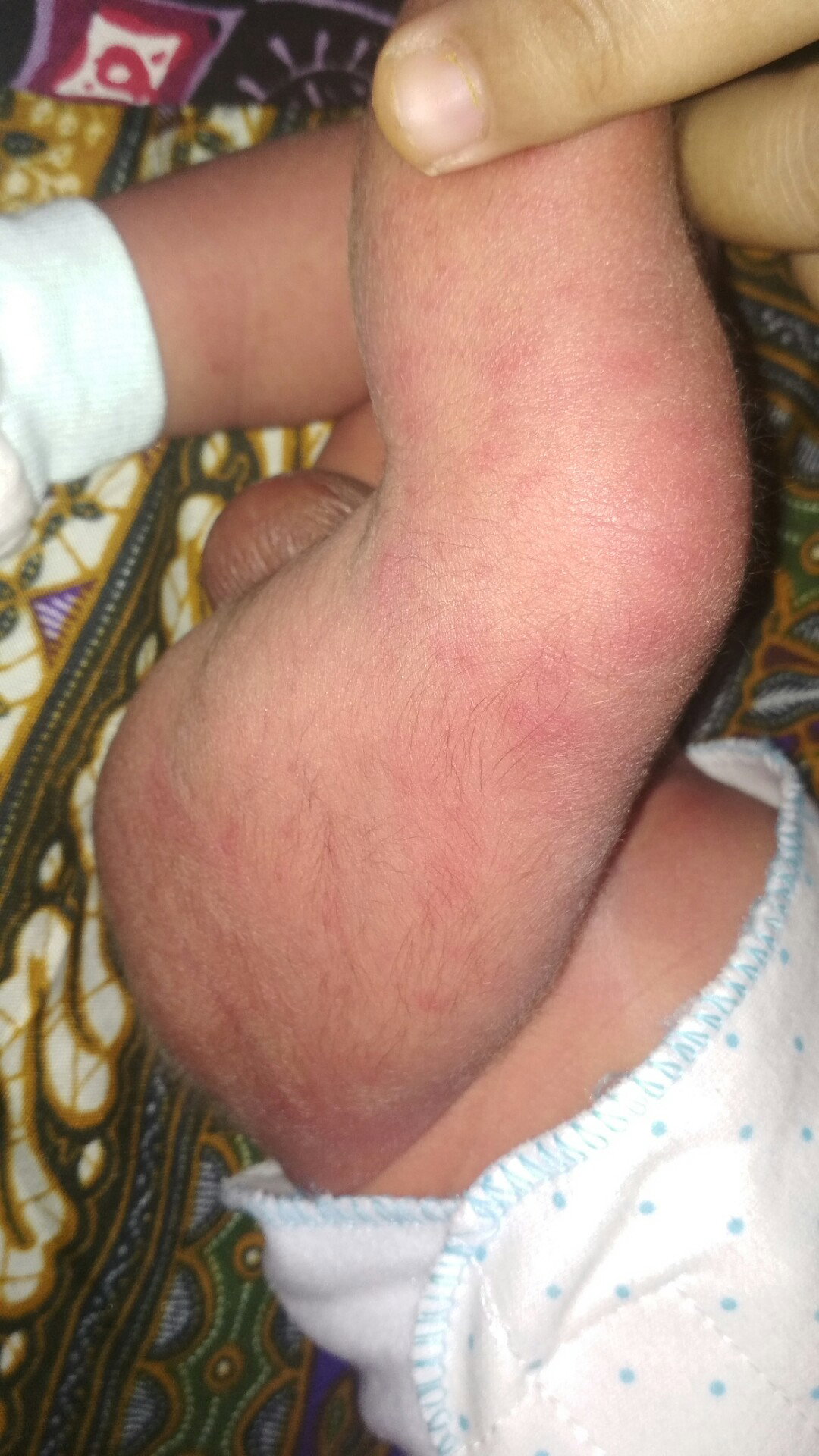 kulit bayi merah