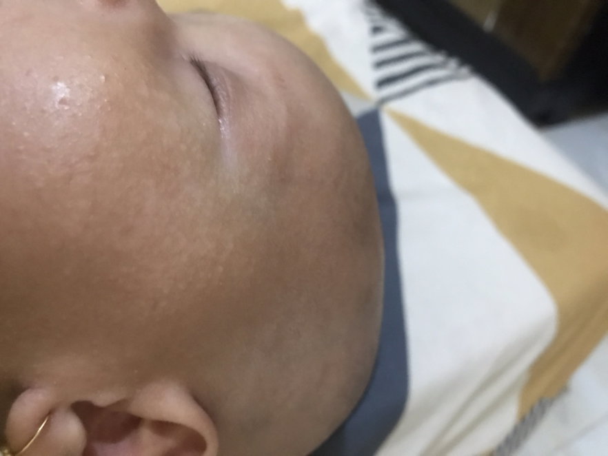 anak ruam putih
