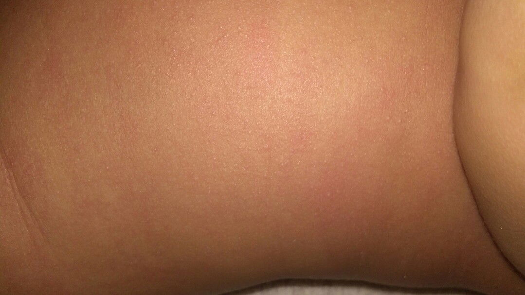 kulit kemerahan dan beruntus di samping perut