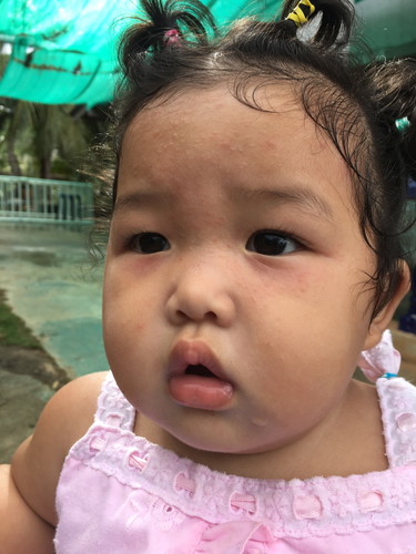 น้องเป็นผื่น