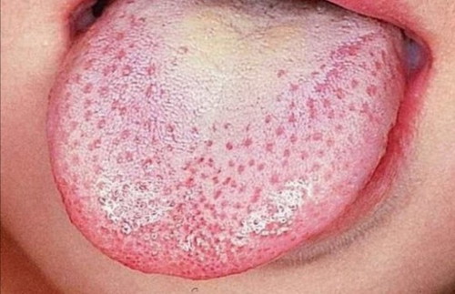 Oral Thrush