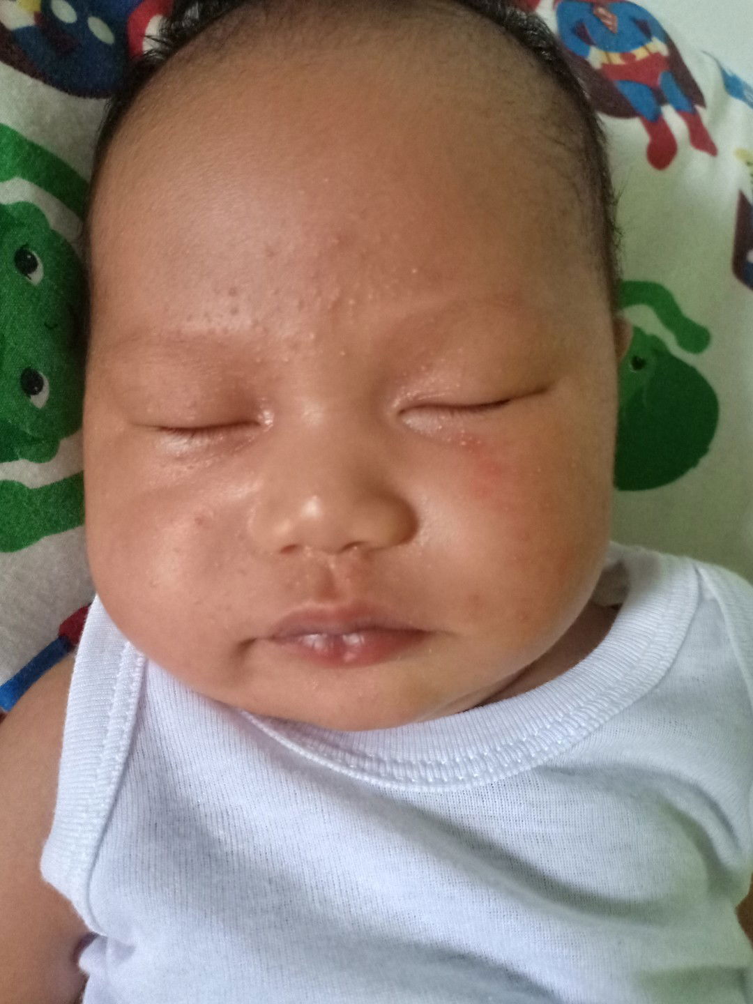 Milia pada kulit muka bayi