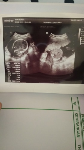 calon bayi tengkurap