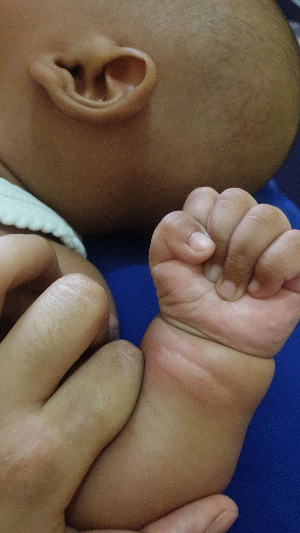 ini bentol apa bukan