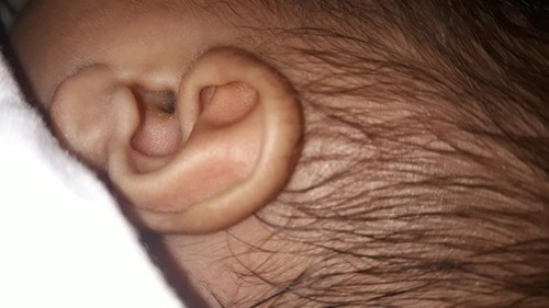 kotoran telinga bayi