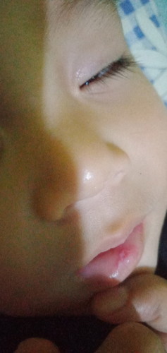 sariawan