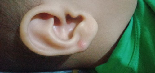 benjolan