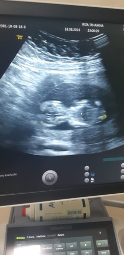 Janin umur 11 week 5 day