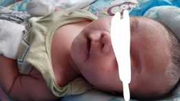 RASHES AND CRADLE CRAP