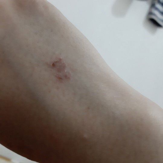 gatel2,kulit kering dan gentol saat hamil