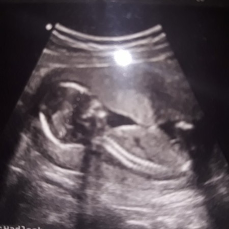 USG bayi seperti kesempitan