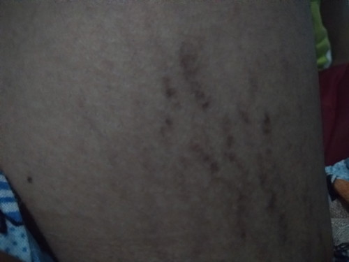 Stretch Mark