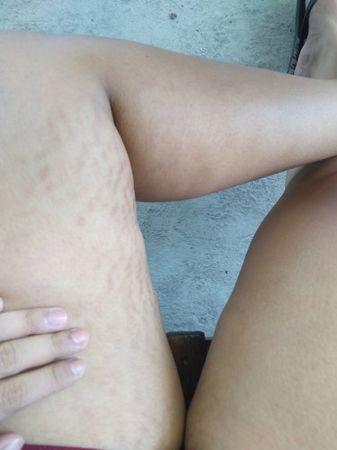 postpartum skin/stretch marks