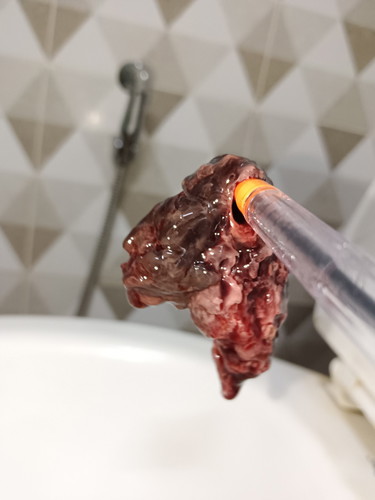 ปวดท้องหลังคลอด 1 เดือน