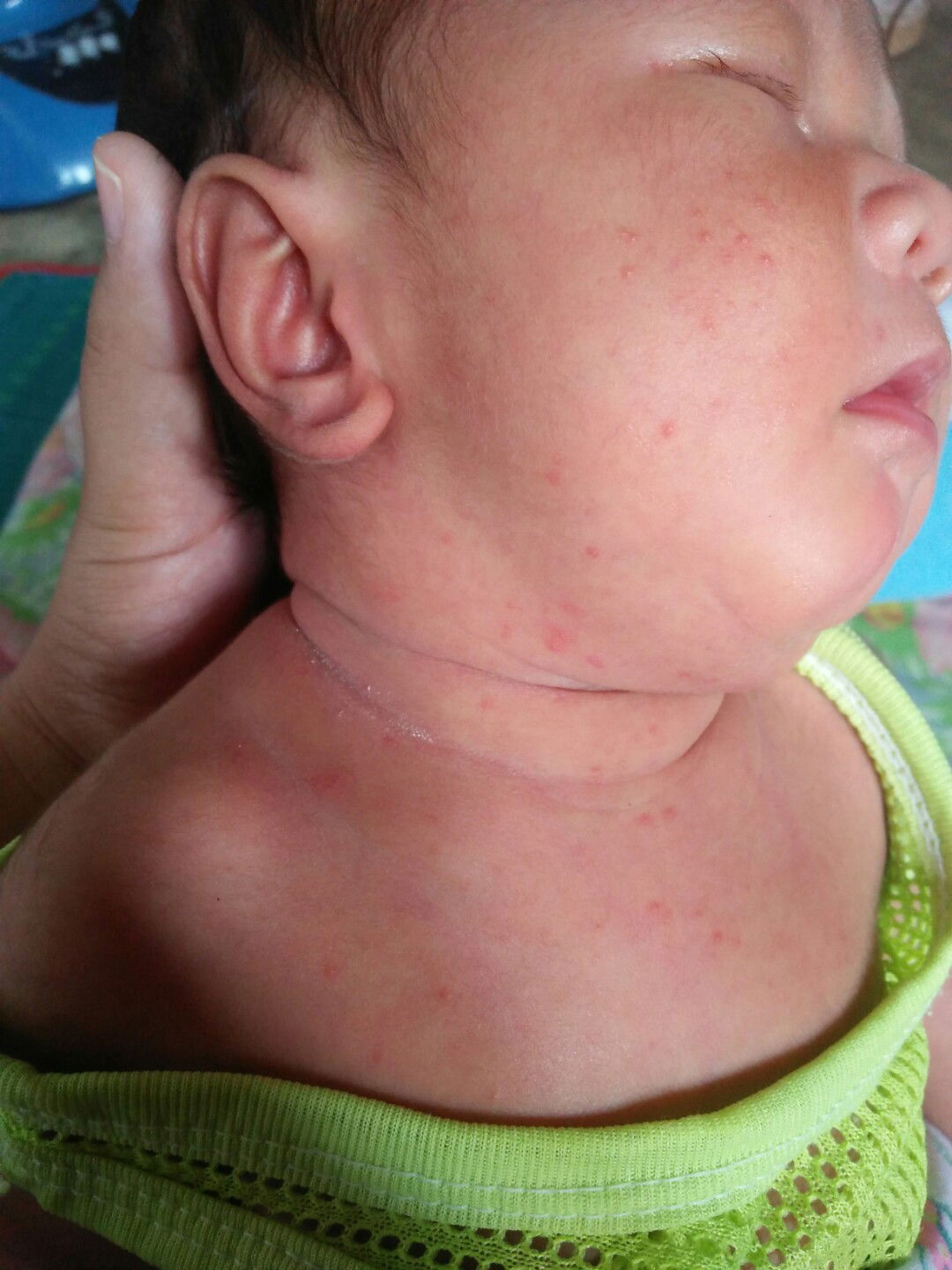 ผดร้อนหรือน้องแพ้อาหารที่แม่กิน