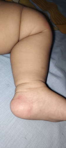 Muncul bentol merah berair pada anak
