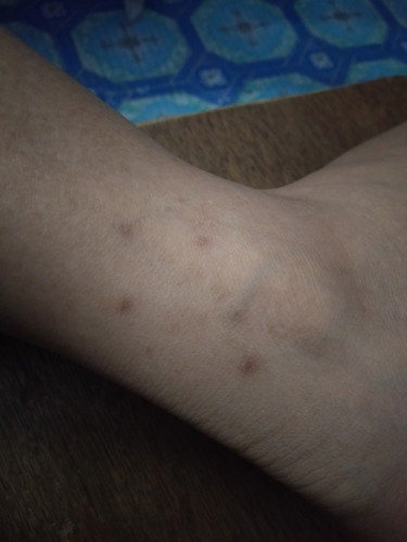 REMEDY FOR INSECT BITES