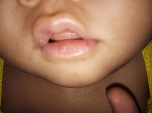 Chapped/cracked Lips