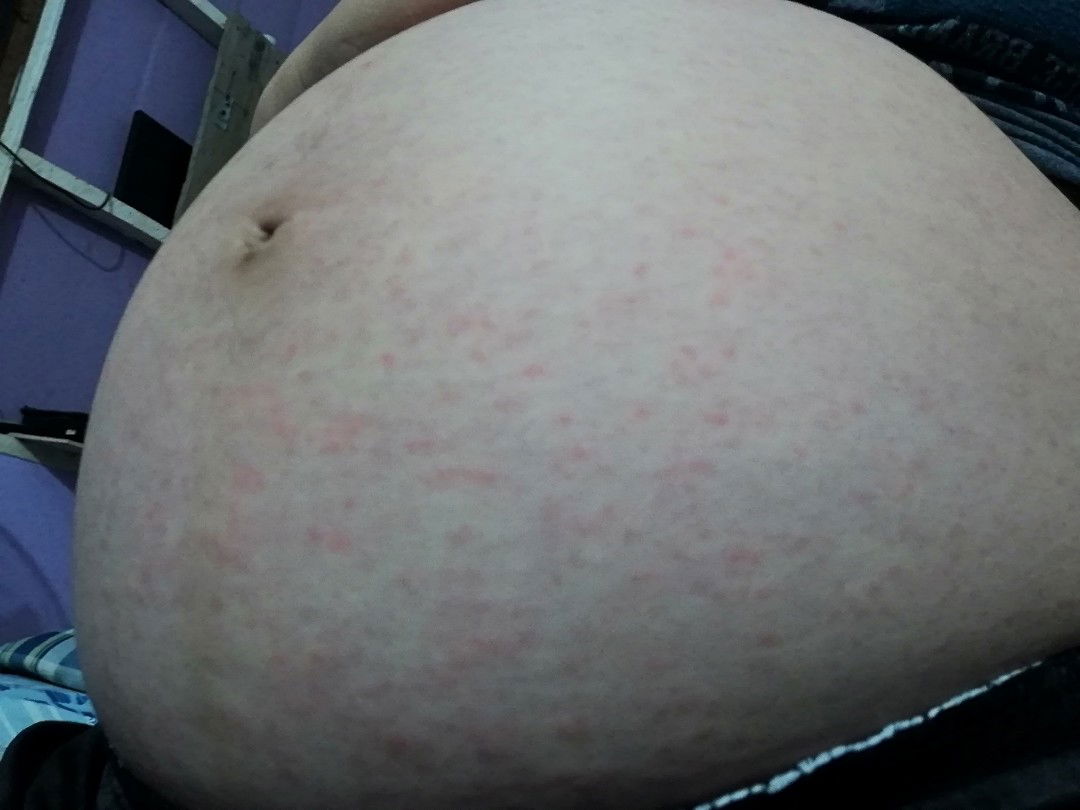 ท้องไม่ลาย แต่ได้อย่างอื่นมาแทน