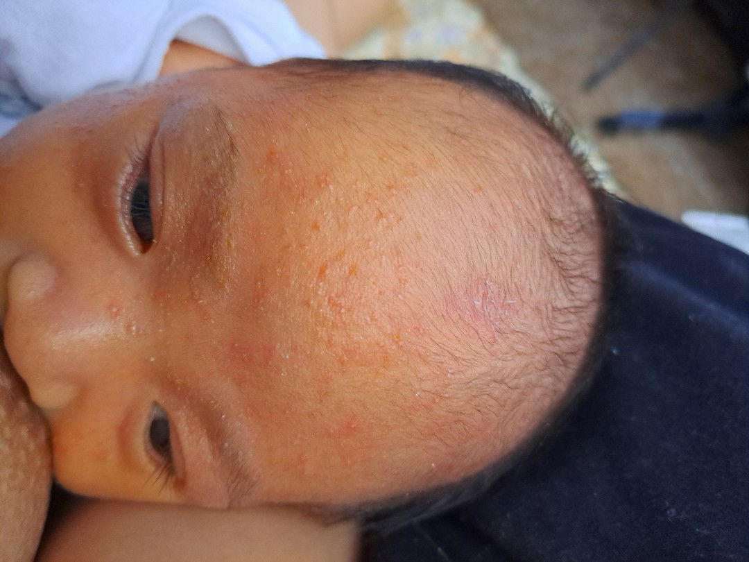 RASHES REMEDY O ALLERGY