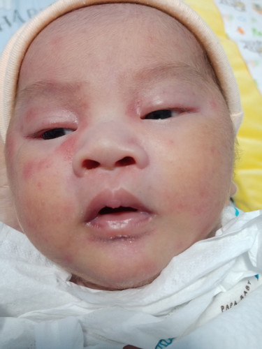 ผื่นแดง