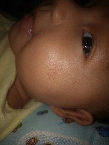 Pipi merah dan bersisik