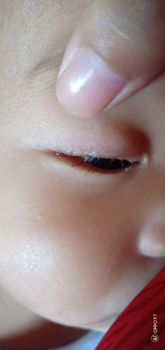 น้องมีขี้ตาและน้ำตาออกมา