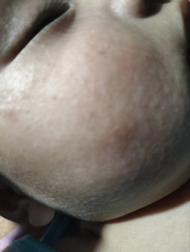 rashes sa pisngi