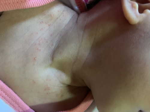 ลูกมีผื่นแดงที่คอ