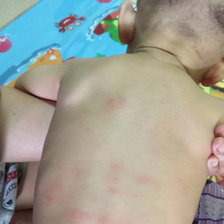 มีลูกใครผื่นขึ้นแบบนี้บ้างค่ะหาหมอแล้วกินยาแล้วยังไม่ดีขึ้นค่ะ