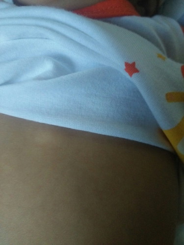 bukol
