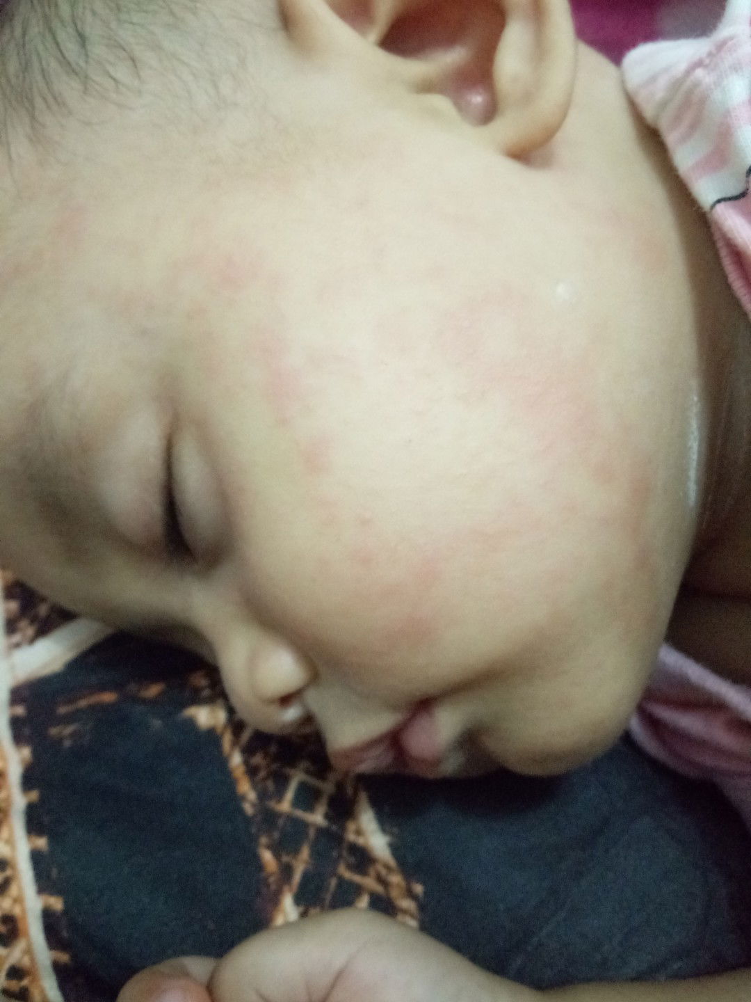 Bintik Merah Pada Bayi