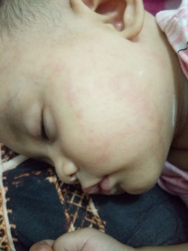 Bintik Merah Pada Bayi