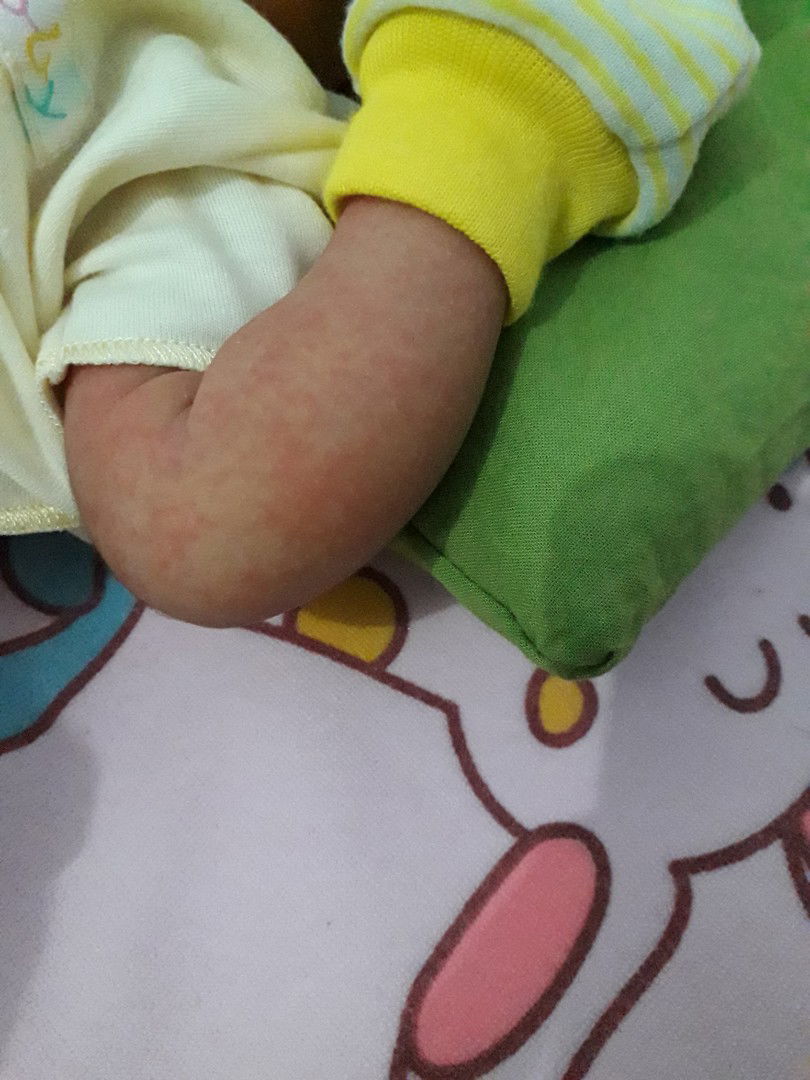 kulit bayi merah
