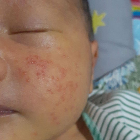 ruam dan brutusan kecil di pipi
