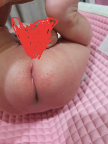ผื่นที่ก้น
