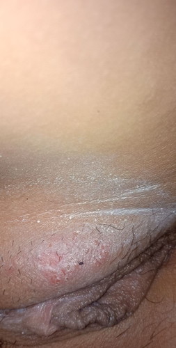 Rashes na kumakalat.