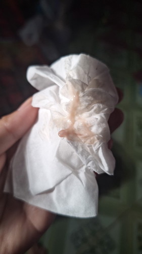 ท้องได้7+6ค่ะเเบบนี้ปกติหรือผิดปกติค่ะมีตกขาวสีชมพู่ออกมาค่ะขอคำตอบหน่อยน่ะค่ะท้องเเรกค่ะ🙏🙏🙏