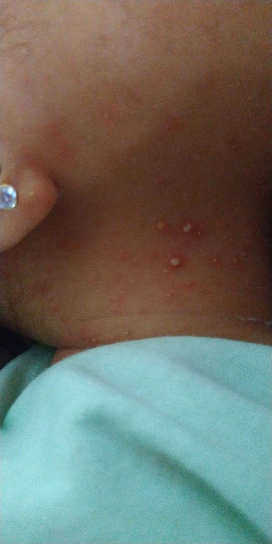 Penyakit Kulit Pada Bayi