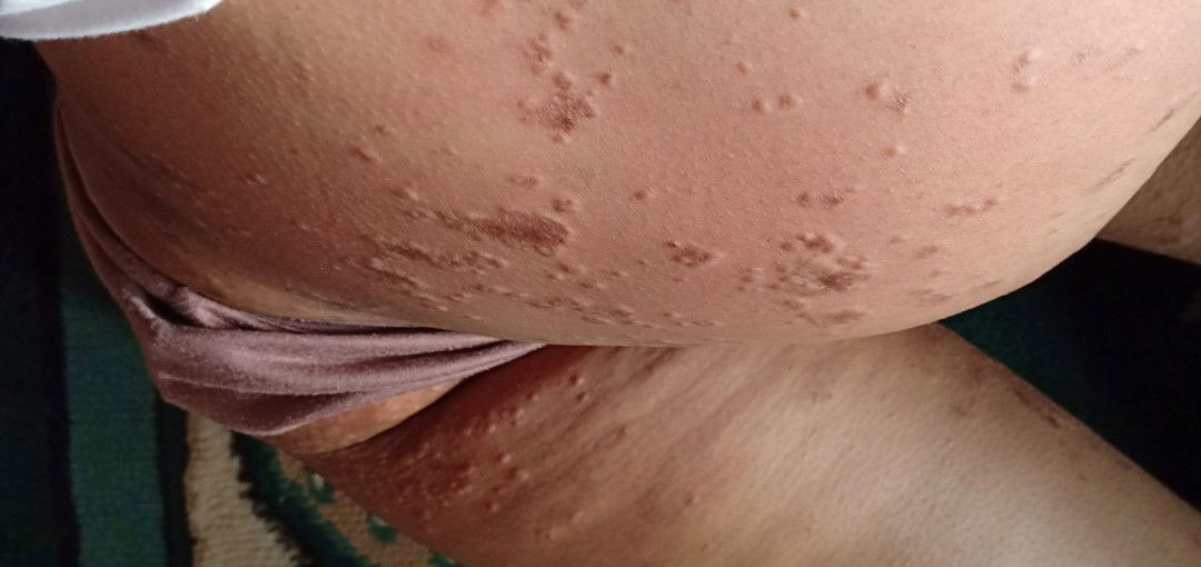 Gatal-gatal parah saat hamil tua