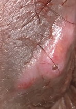 KELOID SA PWERTA(SORRY FOR THE PICTURE)