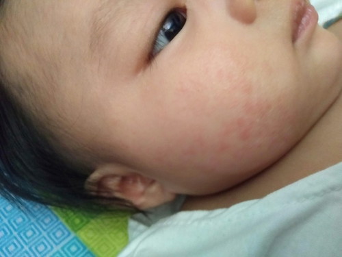 2months RASHES